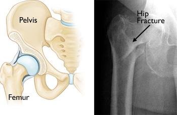 Hip Joint Fracture