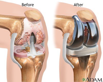 KNEE REPLACEMENT