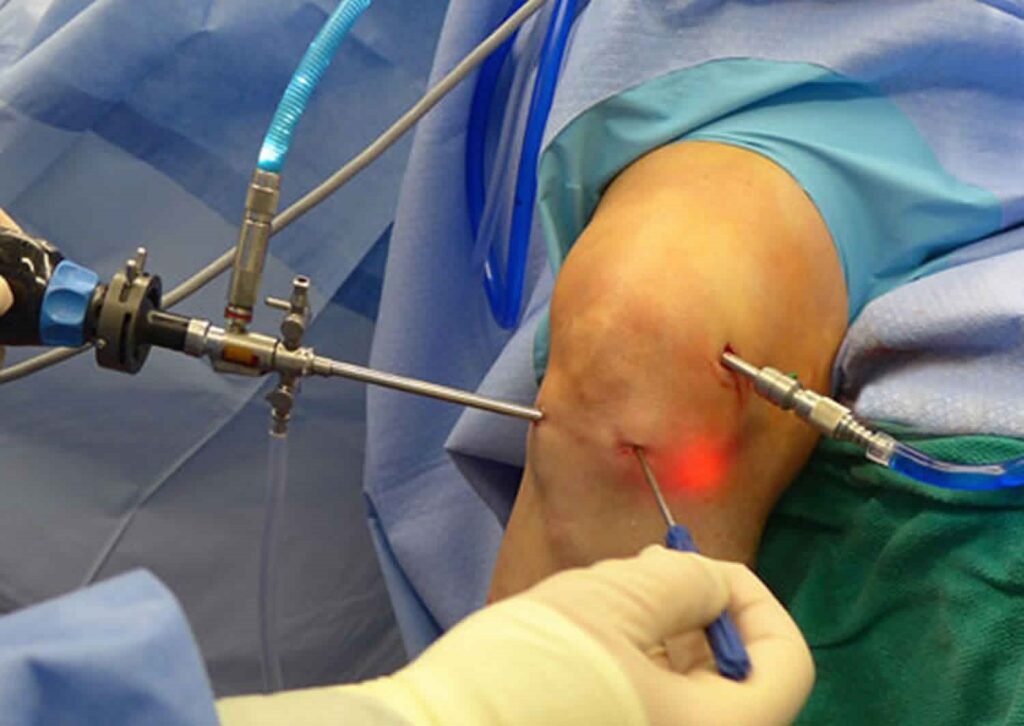 Knee Arthroscopy