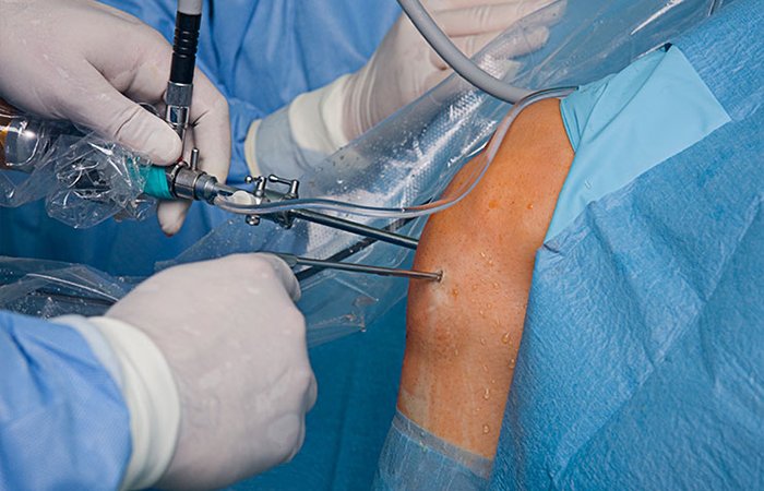 Arthroscopic  Surgeries