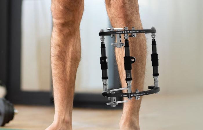 Deformity Correction Surgeries